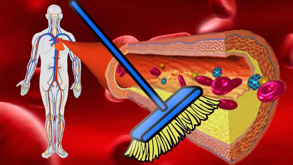 Чистка сосудов: что это, и можно ли убрать холестериновые бляшки?